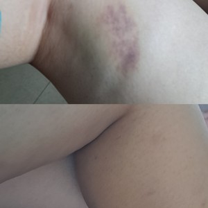 撞瘀青了腳，用薰衣草散瘀＊